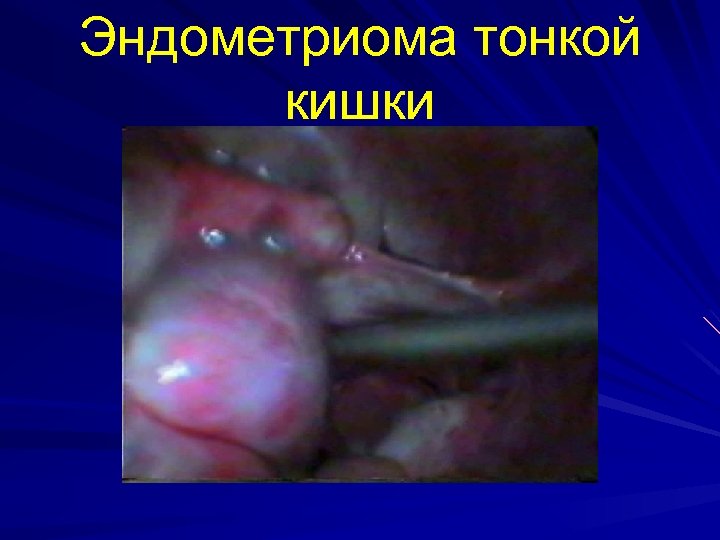 Эндометриома тонкой кишки 