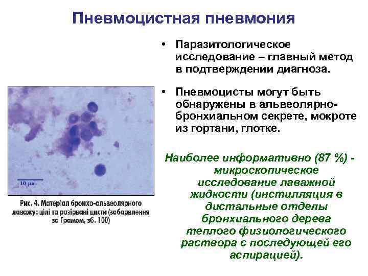 Пневмоцистная пневмония