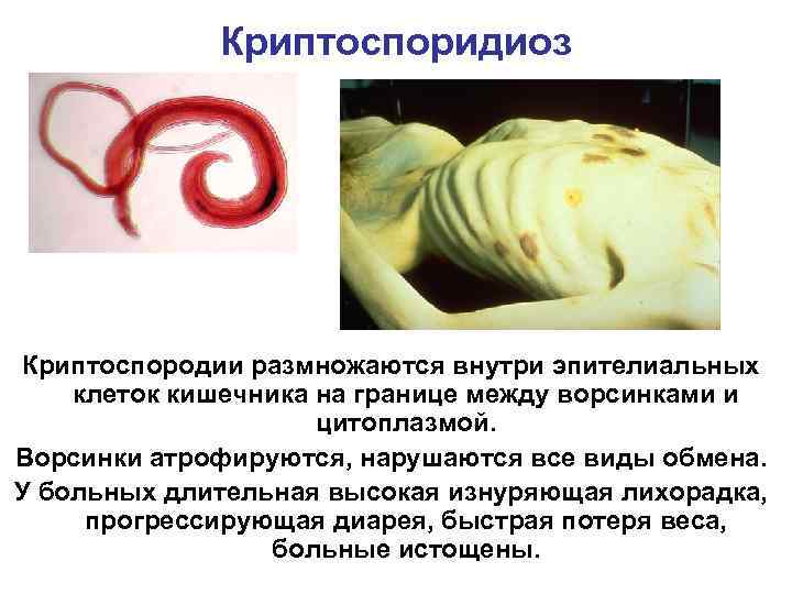 Криптоспоридиоз Криптоспородии размножаются внутри эпителиальных клеток кишечника на границе между ворсинками и цитоплазмой. Ворсинки