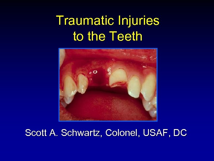 Traumatic Injuries to the Teeth Scott A. Schwartz, Colonel, USAF, DC 