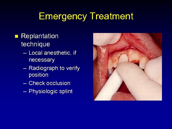 Emergency Treatment n Replantation technique – Local anesthetic, if necessary – Radiograph to verify