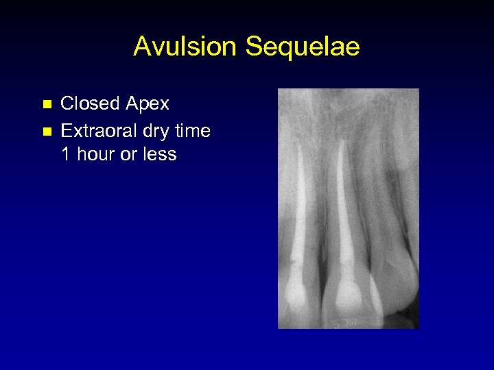 Avulsion Sequelae n n Closed Apex Extraoral dry time 1 hour or less 