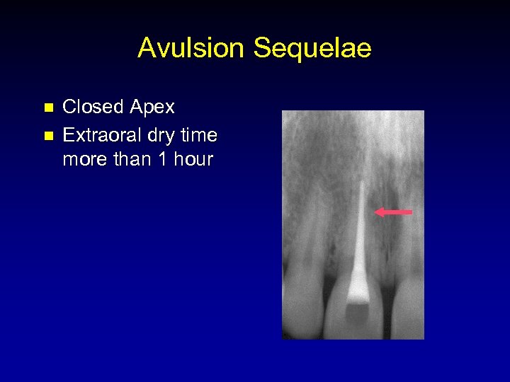 Avulsion Sequelae n n Closed Apex Extraoral dry time more than 1 hour 