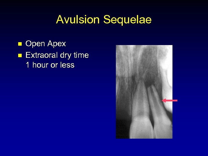 Avulsion Sequelae n n Open Apex Extraoral dry time 1 hour or less 