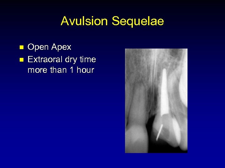 Avulsion Sequelae n n Open Apex Extraoral dry time more than 1 hour 