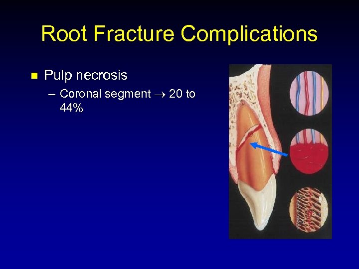 Root Fracture Complications n Pulp necrosis – Coronal segment 20 to 44% 