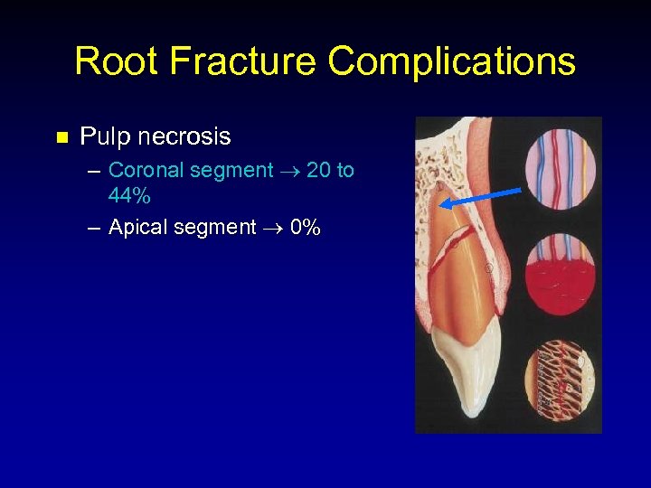 Root Fracture Complications n Pulp necrosis – Coronal segment 20 to 44% – Apical