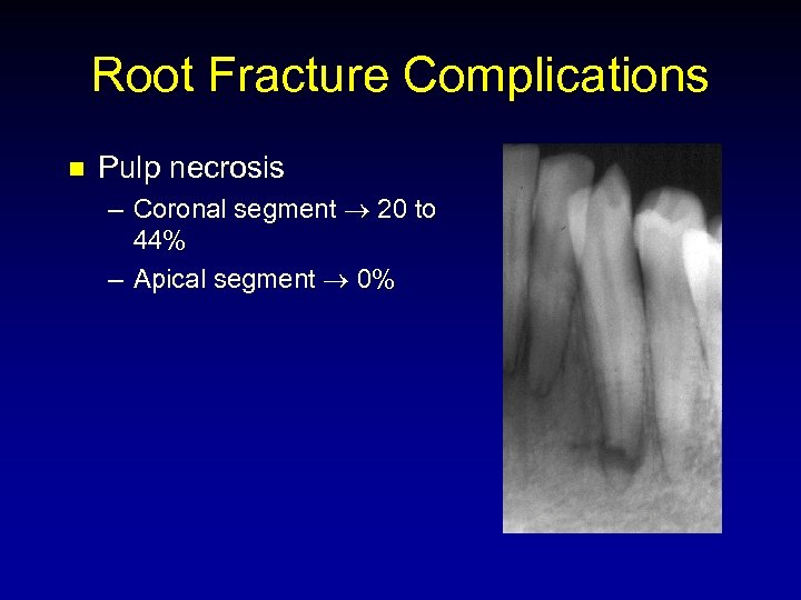 Root Fracture Complications n Pulp necrosis – Coronal segment 20 to 44% – Apical