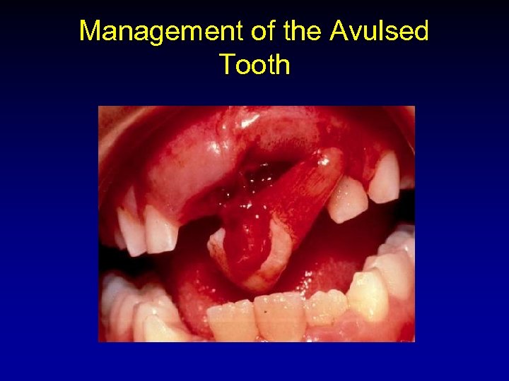 Management of the Avulsed Tooth 