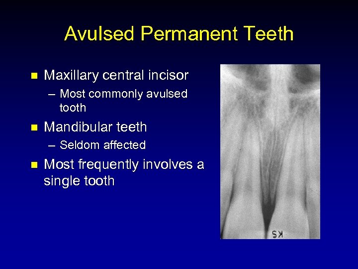 Avulsed Permanent Teeth n Maxillary central incisor – Most commonly avulsed tooth n Mandibular