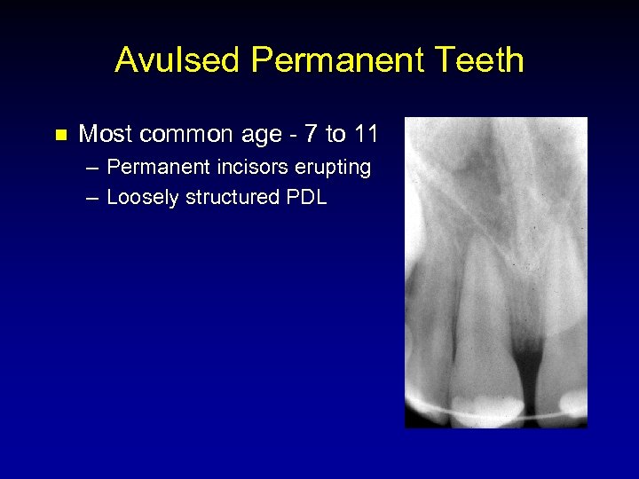 Avulsed Permanent Teeth n Most common age - 7 to 11 – Permanent incisors