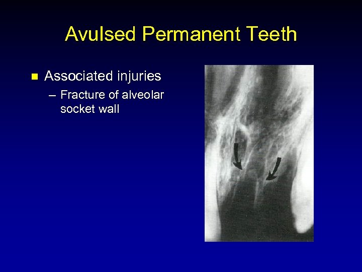 Avulsed Permanent Teeth n Associated injuries – Fracture of alveolar socket wall 