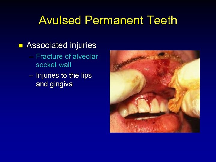 Avulsed Permanent Teeth n Associated injuries – Fracture of alveolar socket wall – Injuries