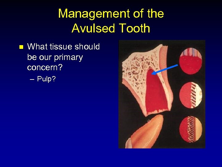 Management of the Avulsed Tooth n What tissue should be our primary concern? –