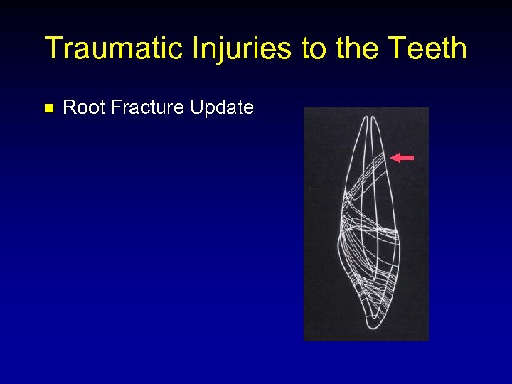 Traumatic Injuries to the Teeth n Root Fracture Update 