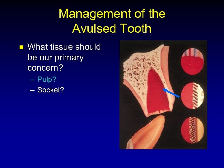 Management of the Avulsed Tooth n What tissue should be our primary concern? –