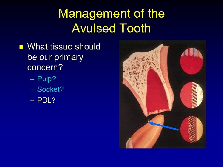 Management of the Avulsed Tooth n What tissue should be our primary concern? –