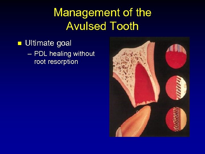 Management of the Avulsed Tooth n Ultimate goal – PDL healing without root resorption