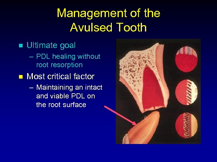 Management of the Avulsed Tooth n Ultimate goal – PDL healing without root resorption