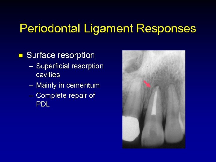 Periodontal Ligament Responses n Surface resorption – Superficial resorption cavities – Mainly in cementum