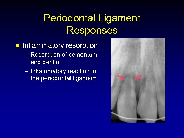 Periodontal Ligament Responses n Inflammatory resorption – Resorption of cementum and dentin – Inflammatory