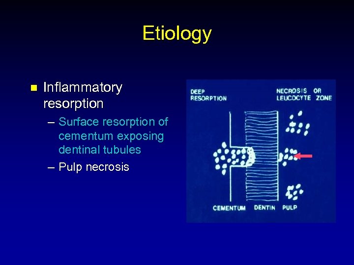 Etiology n Inflammatory resorption – Surface resorption of cementum exposing dentinal tubules – Pulp
