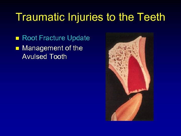 Traumatic Injuries to the Teeth n n Root Fracture Update Management of the Avulsed