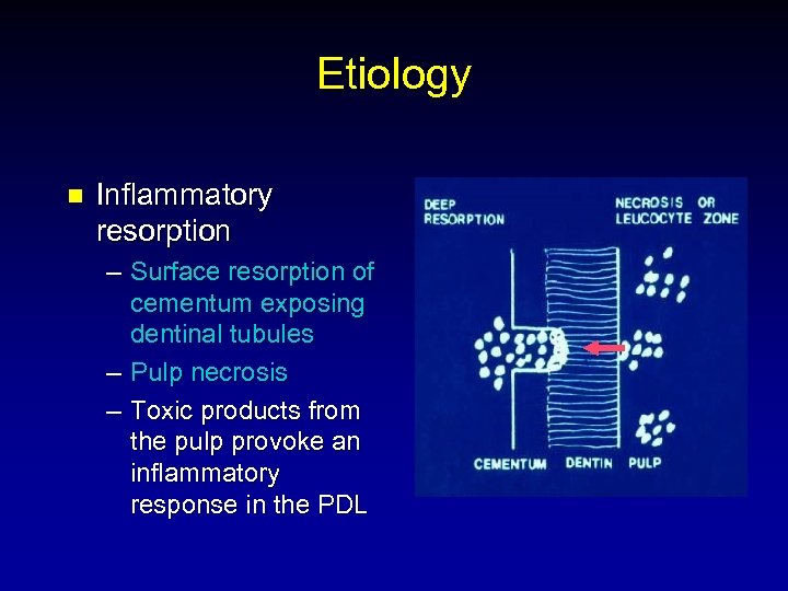 Etiology n Inflammatory resorption – Surface resorption of cementum exposing dentinal tubules – Pulp