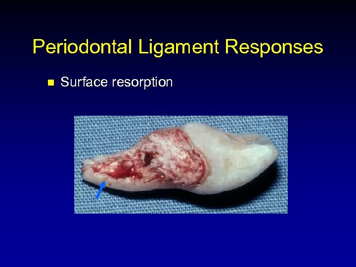 Periodontal Ligament Responses n Surface resorption 