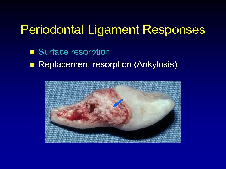 Periodontal Ligament Responses n n Surface resorption Replacement resorption (Ankylosis) 