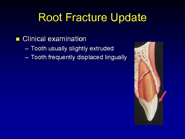 Root Fracture Update n Clinical examination – Tooth usually slightly extruded – Tooth frequently