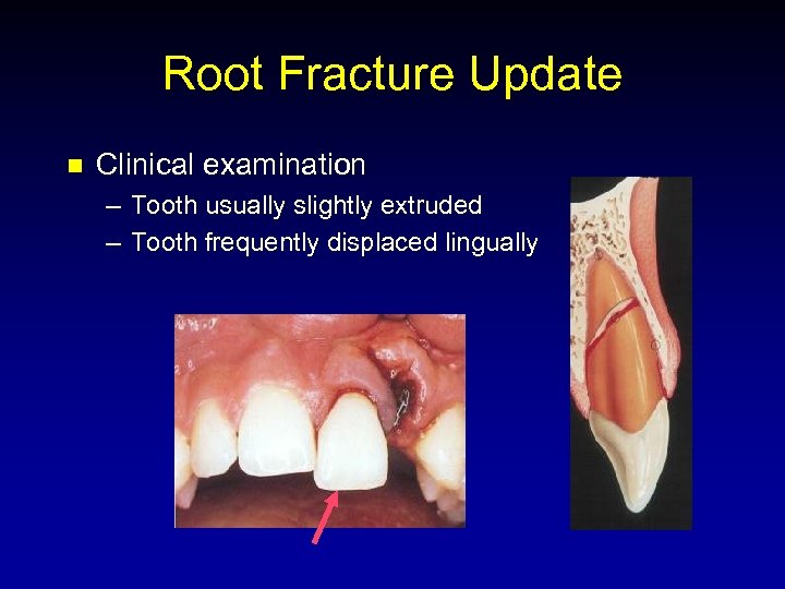 Root Fracture Update n Clinical examination – Tooth usually slightly extruded – Tooth frequently