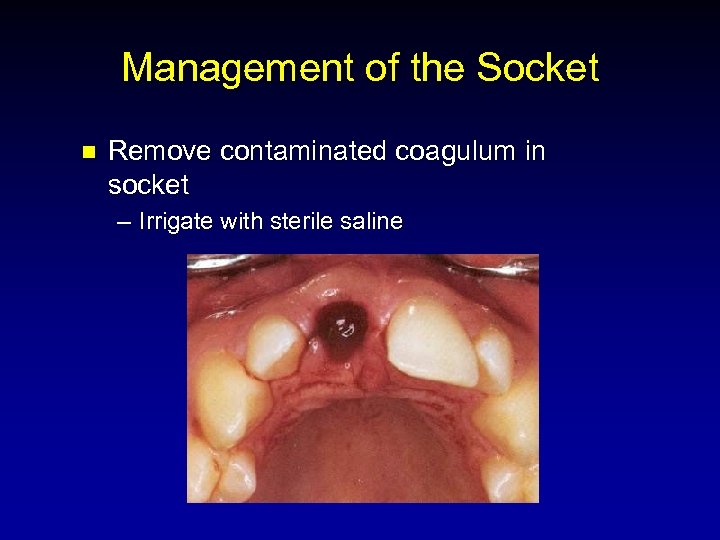 Management of the Socket n Remove contaminated coagulum in socket – Irrigate with sterile