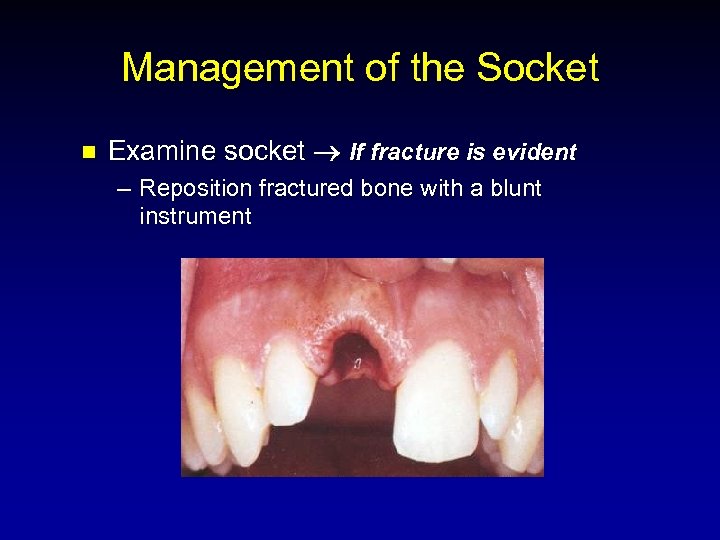 Management of the Socket n Examine socket If fracture is evident – Reposition fractured