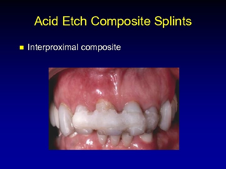 Acid Etch Composite Splints n Interproximal composite 