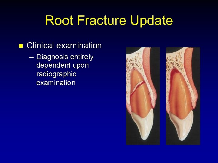 Root Fracture Update n Clinical examination – Diagnosis entirely dependent upon radiographic examination 