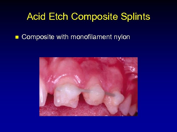 Acid Etch Composite Splints n Composite with monofilament nylon 