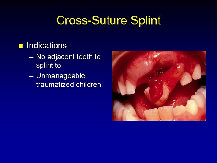 Cross-Suture Splint n Indications – No adjacent teeth to splint to – Unmanageable traumatized