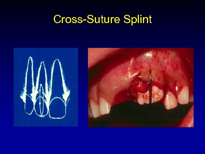Cross-Suture Splint 