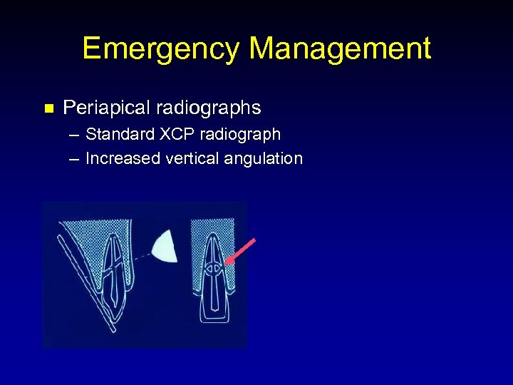 Emergency Management n Periapical radiographs – Standard XCP radiograph – Increased vertical angulation 