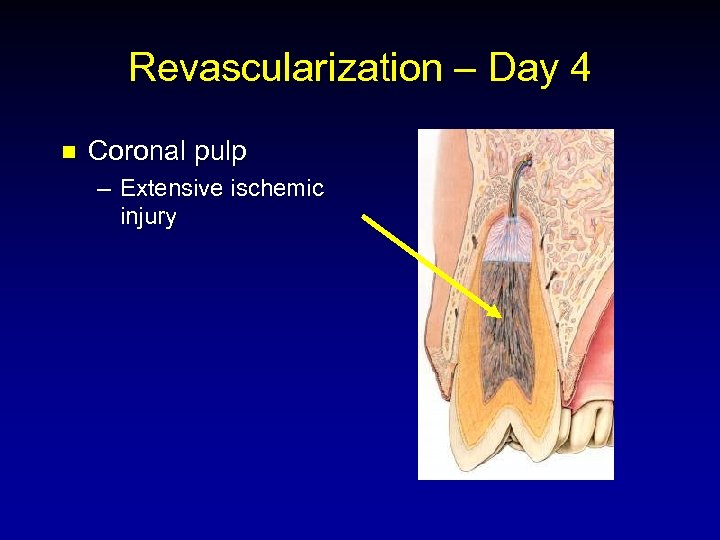 Revascularization – Day 4 n Coronal pulp – Extensive ischemic injury 
