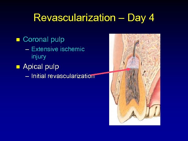 Revascularization – Day 4 n Coronal pulp – Extensive ischemic injury n Apical pulp