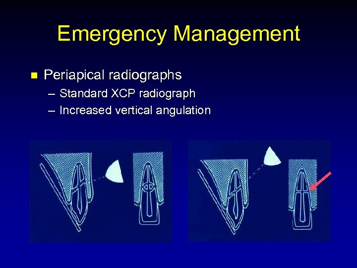 Emergency Management n Periapical radiographs – Standard XCP radiograph – Increased vertical angulation 