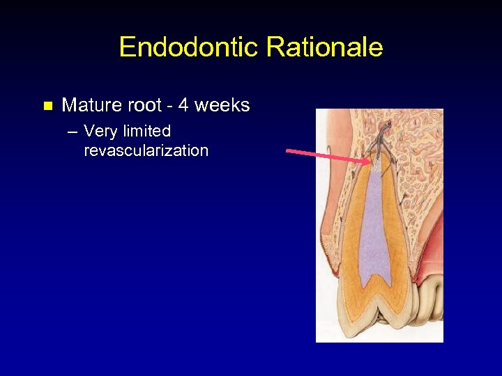 Endodontic Rationale n Mature root - 4 weeks – Very limited revascularization 