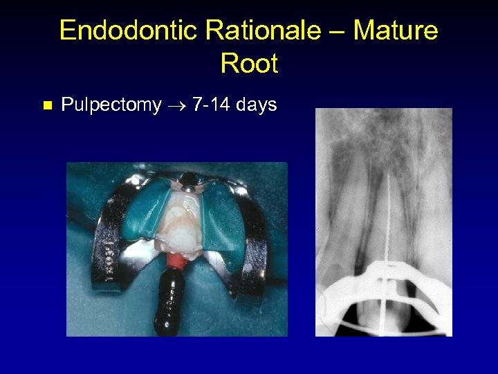 Endodontic Rationale – Mature Root n Pulpectomy 7 -14 days 