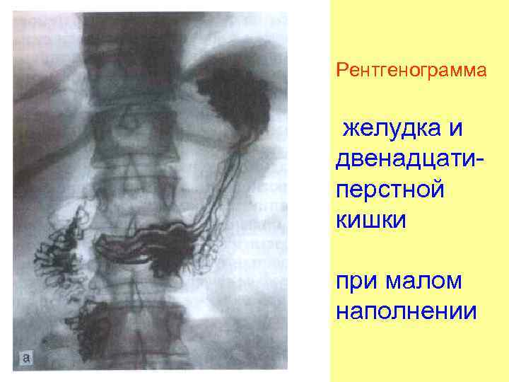 Рентгенограмма желудка и двенадцатиперстной кишки при малом наполнении 