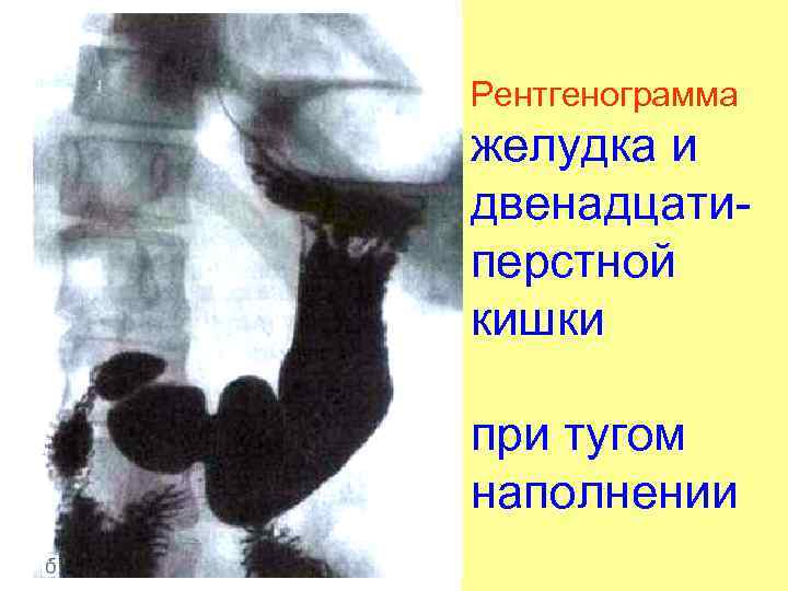 Рентгенограмма желудка и двенадцатиперстной кишки при тугом наполнении 