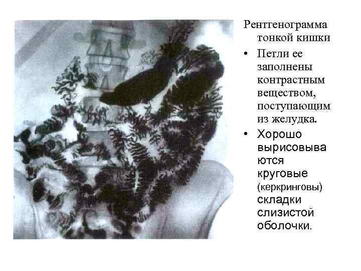 Рентгенограмма тонкой кишки • Петли ее заполнены контрастным веществом, поступающим из желудка. • Хорошо