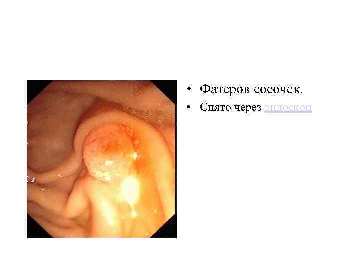  • Фатеров сосочек. • Снято через эндоскоп 