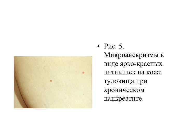  • Рис. 5. Микроаневризмы в виде ярко-красных пятнышек на коже туловища при хроническом